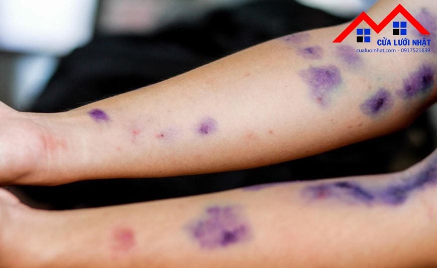 Vết bỏng do kiến ba khoang - Ảnh: CHÂU TUẤN